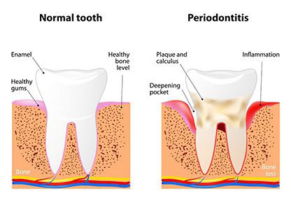 Periodontal Treatment